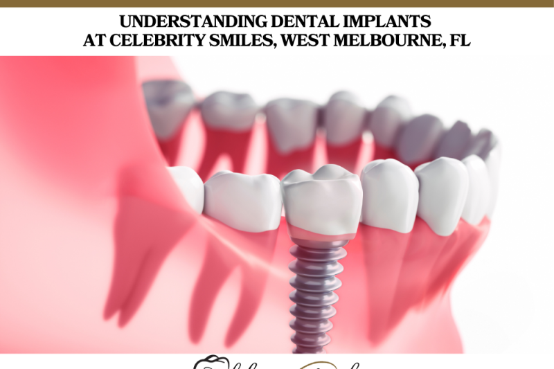 Understanding Dental Implants at Celebrity Smiles, West Melbourne, FL