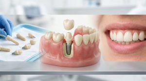 Do West Melbourne Oral Surgeons Offer Metal-Free Zirconia Dental Implants